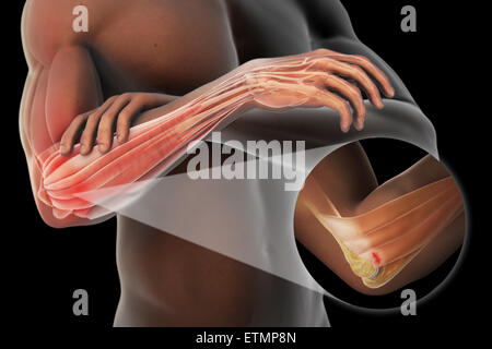 Abbildung des Armes mit transparente Haut, Verletzungen an der seitlichen Epicondylus Sehne, bekannt als laterale Epicondylitis oder Tennisarm zu zeigen. Stockfoto