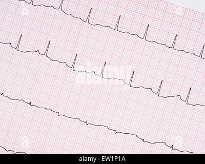 Gesundes Herz etc.. Echte Elektrokardiogramm EKG Ausdruck Detail. Stockfoto