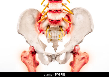 Illustrative Grafik von Morbus Bechterew - eine degenerative Form der Arthritis die Iliosakralgelenke die Spineand. Stockfoto