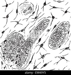 Grandular Karzinom, bei der das Stroma in schleimigen Gewebe, Vintage gravierte Darstellung umgewandelt hat. Stock Vektor