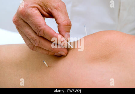 Arzt benutzt Akupunkturnadeln auf das Knie einer Frau Stockfoto