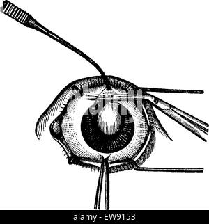 Iridektomie, graviert mit Zange entfernen eine Klappe aus dem oberen Teil der Iris vor der Kataraktoperation, Jahrgang illustra Stock Vektor