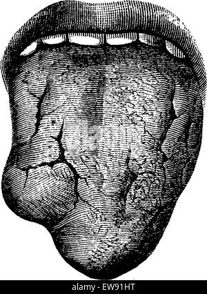 Tumoren und syphilitische Geschwüre der menschlichen Zunge, graviert Vintage Illustration. Üblichen Medizin Wörterbuch von Dr. Labarthe- Stock Vektor
