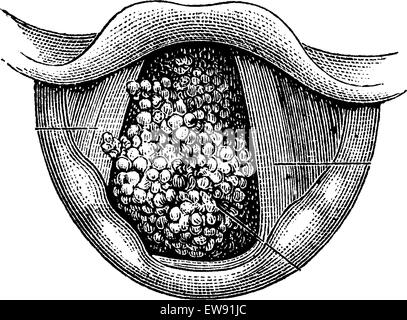 Papillom des Kehlkopfes, graviert Vintage Illustration. Üblichen Medizin Wörterbuch von Dr. Labarthe - 1885 Stock Vektor