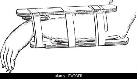 Nelaton-Gerät für Frakturen des distalen Radius, graviert Vintage Illustration. Üblichen Medizin Wörterbuch von Dr. Labarthe - 1885 Stock Vektor