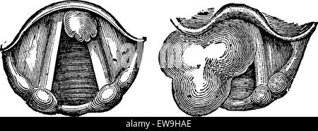 Myome des Kehlkopfes, graviert Vintage Illustration. Üblichen Medizin Wörterbuch von Dr. Labarthe - 1885 Stock Vektor