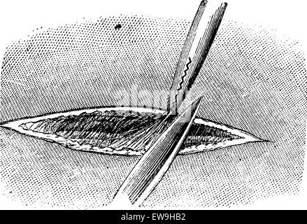 Dissektion der Haut zu entdecken die Arterie, Vintage gravierten Abbildung. Üblichen Medizin Wörterbuch - Paul Labarthe - 1885. Stock Vektor