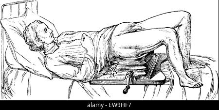 Thema betrieben auf dem Gerät für Lithotripsie, Vintage gravierten Abbildung. Üblichen Medizin Wörterbuch - Paul Labarthe - 1885. Stock Vektor