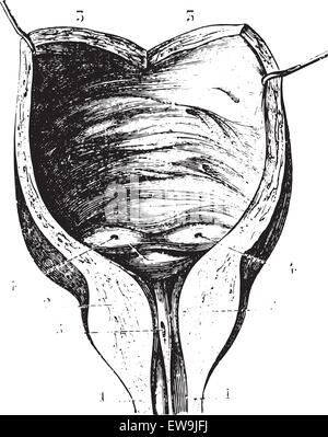 Prostatahypertrophie und anschließende Blase Wände eingraviert Vintage Illustration. Üblichen Medizin Wörterbuch von Dr. Labarthe - 18 Stock Vektor