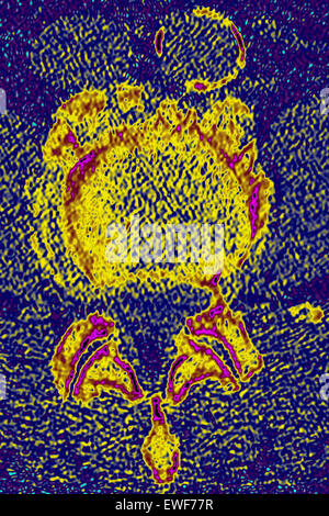 WIRBELKÖRPER ARTHROSE, CT-SCAN Stockfoto