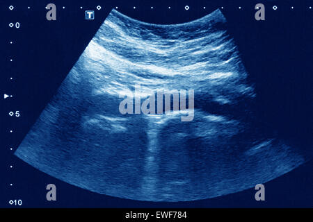 ATHEROMATOUS AORTA, SONOGRAPHIE Stockfoto