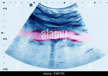 ATHEROMATOUS AORTA, SONOGRAPHIE Stockfoto