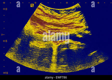 ATHEROMATOUS AORTA, SONOGRAPHIE Stockfoto