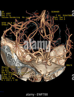 ZEREBRALE ATROPHIE, CT-SCAN Stockfoto