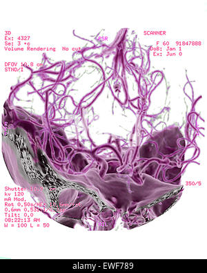 ZEREBRALE ATROPHIE, CT-SCAN Stockfoto