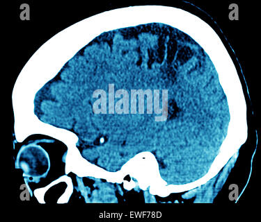 ZEREBRALE ATROPHIE, CT-SCAN Stockfoto