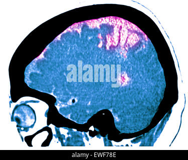 ZEREBRALE ATROPHIE, CT-SCAN Stockfoto