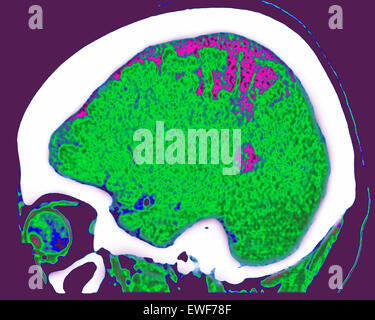 ZEREBRALE ATROPHIE, CT-SCAN Stockfoto