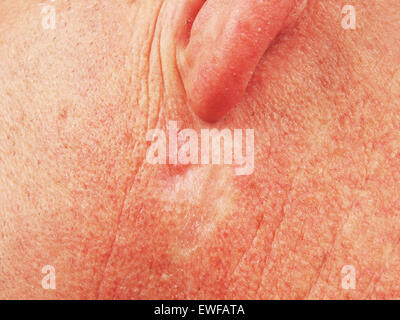 BASALZELL-KARZINOM Stockfoto