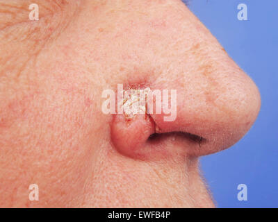 BASALZELL-KARZINOM Stockfoto