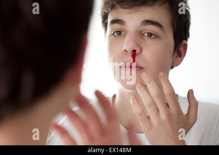 -MODELL VERÖFFENTLICHT. Junger Mann mit Nasenbluten. Stockfoto