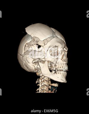 Ansicht von rechts ventral einer dreidimensionalen CT-Rekonstruktion des knöchernen Schädels mit Schussverletzungen zeigt das Loch der Ausfahrt Wunde durch die rechtsseitige zeitlichen Eingang Wunde, 2003 Stockfoto