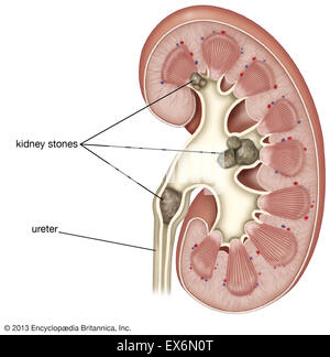 Nierensteine in-situ Stockfoto
