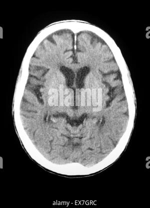 CT-Scan ein 84 Jahre alter Mann mit Alzheimer-Krankheit.  CT zeigt Hirnatrophie. Stockfoto