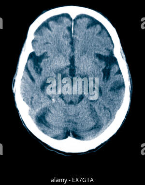 CT-Scan ein 84 Jahre alter Mann mit Alzheimer-Krankheit.  CT zeigt Hirnatrophie. Stockfoto