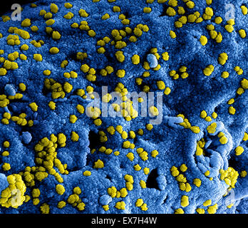 Eingefärbte scanning Electron Schliffbild zeigen Nahen Osten respiratorisches Syndrom Viruspartikel Coronavirus (MERS-CoV). Stockfoto