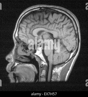 MRI des Kopfes zeigt normale Hirnstrukturen. Stockfoto