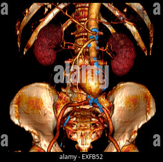 3D Abdominal-angiographischen CT-Scan, abdominalen Aortenaneurysma. Verkalkungen entlang Aorta, Zweige, angibt, Arteriosklerose Stockfoto