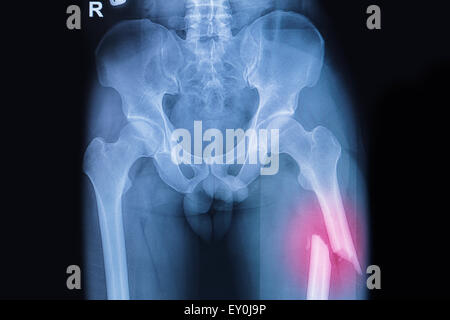 Gebrochenen Oberschenkelknochen gebrochen Oberschenkel Röntgen Bild Stockfoto