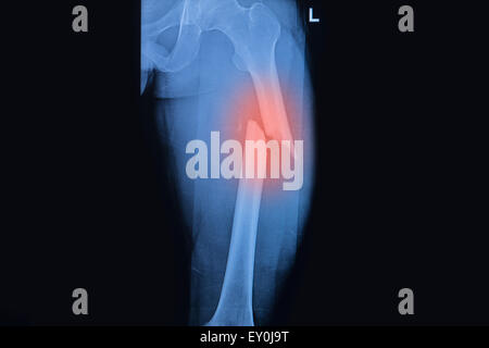 Gebrochenen Oberschenkelknochen gebrochen Oberschenkel Röntgen Bild Stockfoto