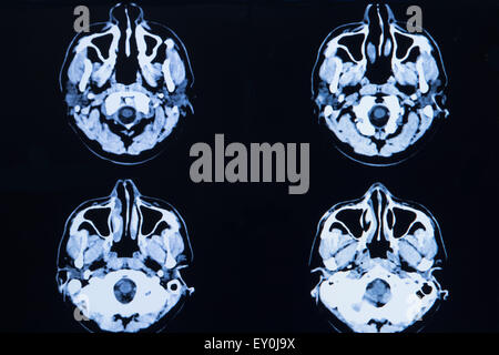 Bilder aus einer Computertomographie des Gehirns und des Schädels Stockfoto