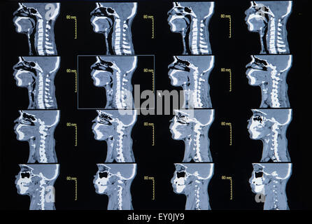 Serie von Bildern aus einer Computertomographie des Halses (zervikale Knochen) Stockfoto