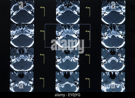 CT-Scan ganze Bauch mit Kontrast Stockfoto