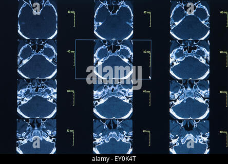 CT-Scan des thorakalen Segment. Wissenschaft-Hintergrund Stockfoto