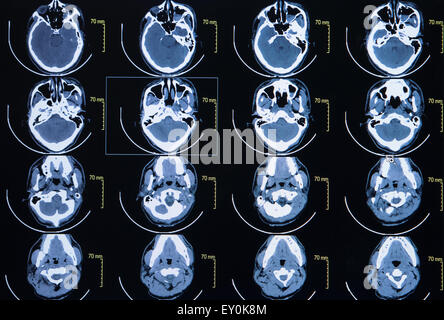 Serie von Bildern aus einer Computertomographie des Gehirns Stockfoto