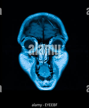MRI-Kopf Magnetresonanz-Bild des Kopfes Scans Stockfoto