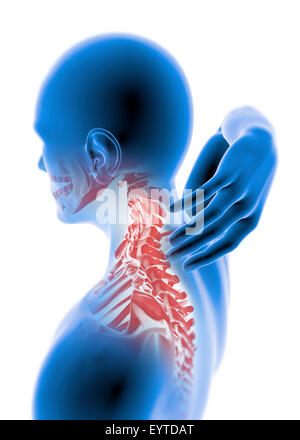 Menschlichen Röntgen mit Schmerzen im Nacken, die isoliert auf weißem Hintergrund Stockfoto