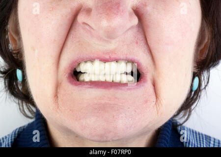 Die ältere Frau mit neuen keramischen Zahnersatz. In der Foto Mängel der Haut klare Sicht - eine Zeit, Muttermale, Haare und Abszesse. Stockfoto