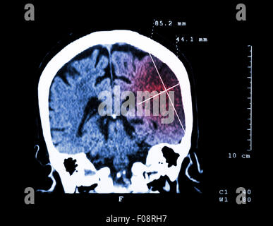 Hirninfarkt am linken Hemisphäre (ischämischer Schlaganfall) (CT-Scan des Gehirns): Medizin und Wissenschaft Hintergrund Stockfoto