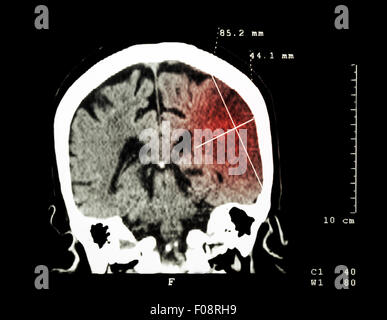 Hirninfarkt am linken Hemisphäre (ischämischer Schlaganfall) (CT-Scan des Gehirns): Medizin und Wissenschaft Hintergrund Stockfoto