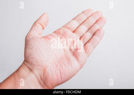 Krank allergische Ausschlag Dermatitis Ekzeme Hautstruktur an Hand des jungen. Stockfoto