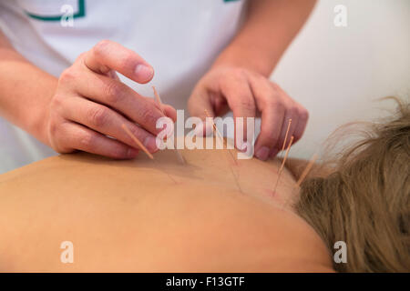 Akupunkturnadeln auf der Rückseite einer jungen Frau Stockfoto