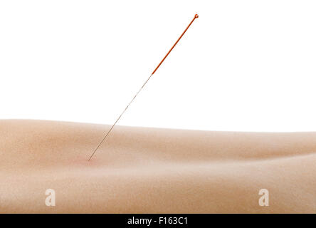Akupunktur, Nadel in die Haut Dorsum, auf weißem Hintergrund, isoliert Stockfoto