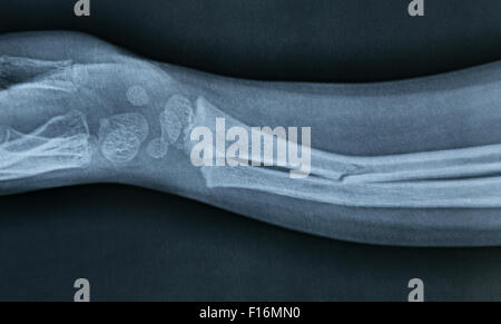 Nahaufnahme einer Brokan Hand Xray Stockfoto