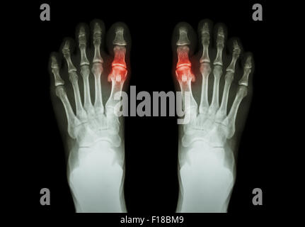 Gicht, rheumatoide Arthritis (Film Röntgen Fuß und Arthritis bei gemeinsamen ersten MTP) (Medizin und Wissenschaft bac Stockfoto