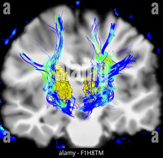 Koronale Ansicht menschlichen Gehirns Parkinson-Krankheit. Gelbe Fläche ist Thalamus blau/grüne Bereiche hervorheben, Fasern-motor-system Stockfoto